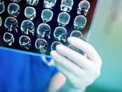 Presurgical imaging may predict whether epilepsy surgery will work